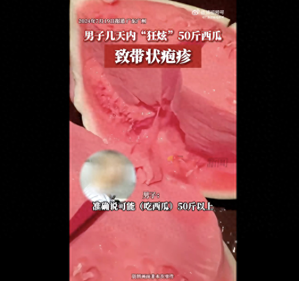 男子几天内狂炫50斤西瓜致带状疱疹,男子有糖尿病病史 影响免疫力(图1)