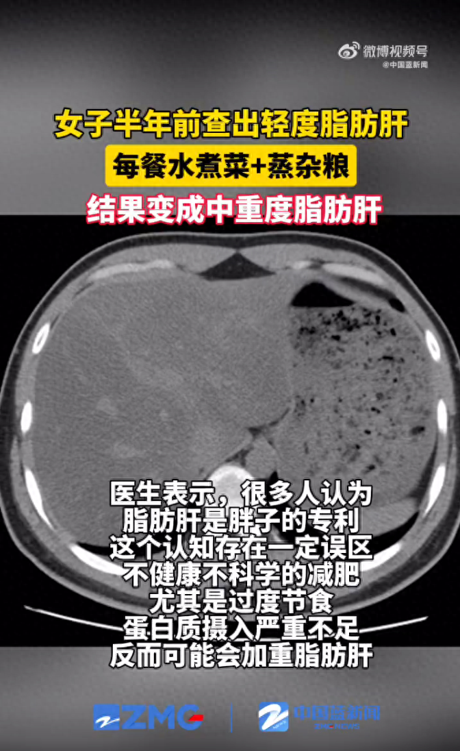 女子吃素半年吃出中重度脂肪肝 专家:过度节食,蛋白质摄入严重不足,可能会加重脂肪肝(图1)