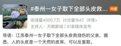 父亲烧伤面积高达95%,22岁女孩取全部头皮救父(图1)