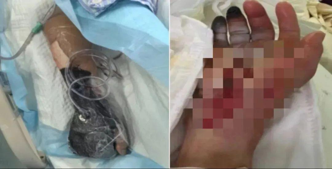 戴手套！戴手套！致死率或达100%！已有人中招(图1)